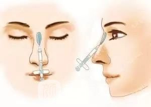 只需要5分鐘，我的鼻子變高了！——南京藝星玻尿酸隆鼻~