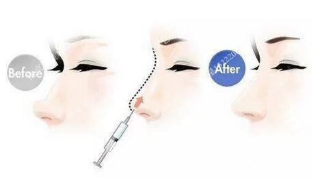 只需要5分鐘，我的鼻子變高了！——南京藝星玻尿酸隆鼻~