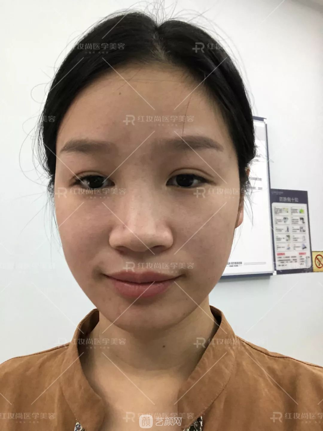 【蛻變?nèi)沼洝拷^美側(cè)顏的秘密——分享我的美鼻之旅~