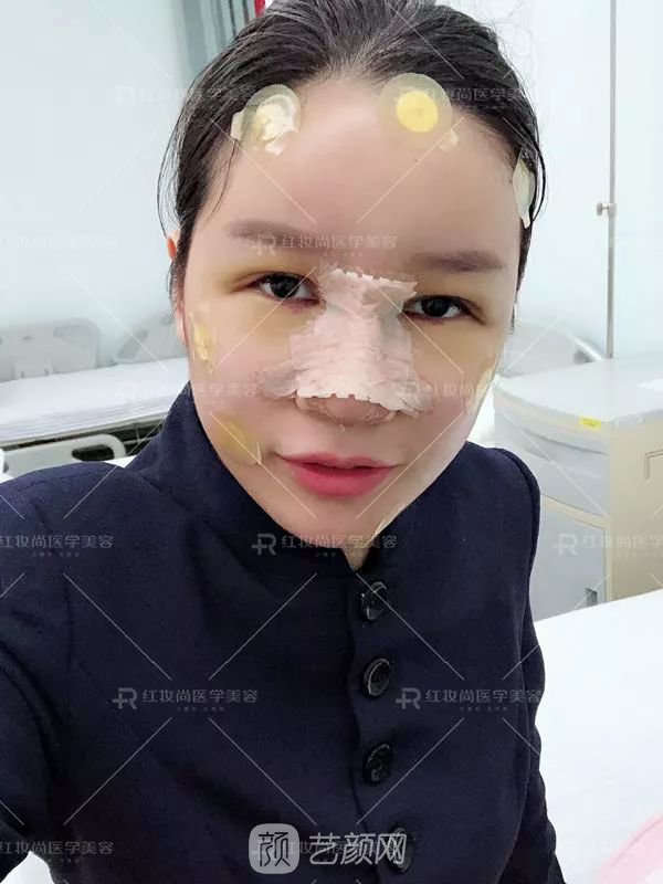 【蛻變?nèi)沼洝拷^美側(cè)顏的秘密——分享我的美鼻之旅~