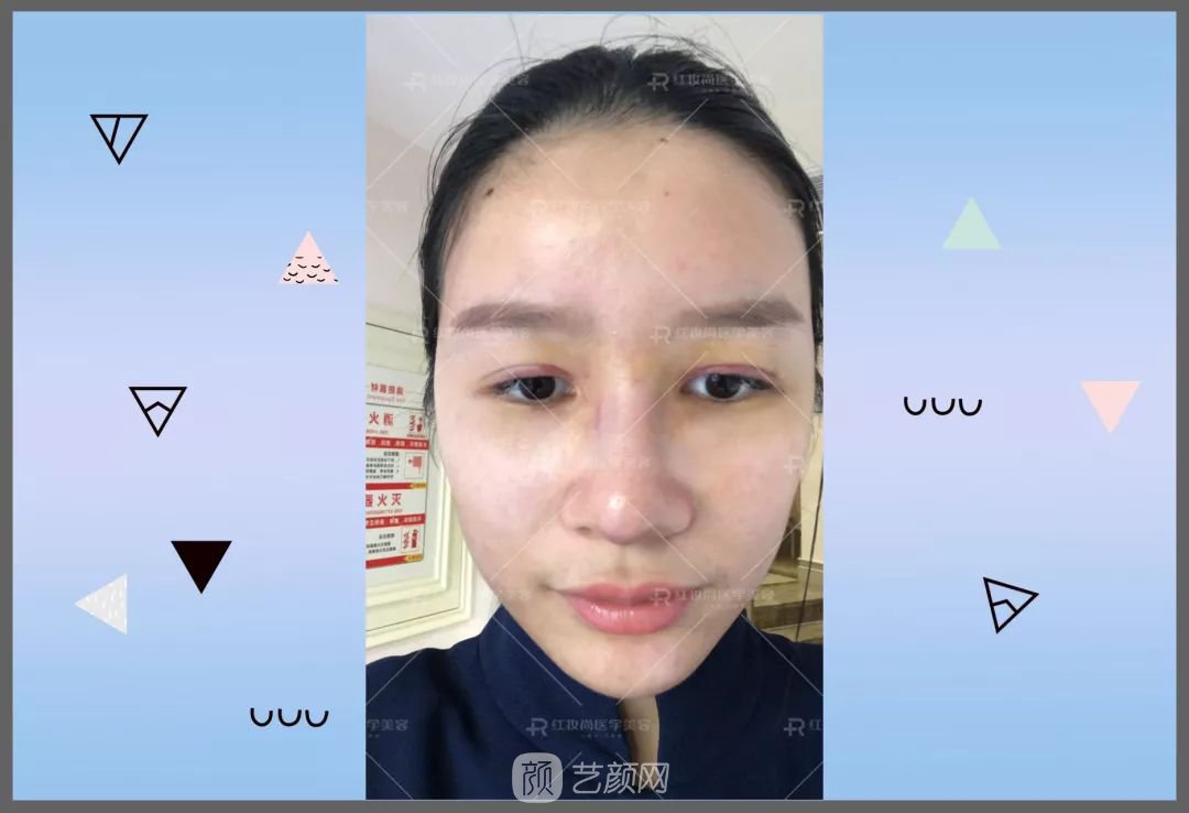 【蛻變?nèi)沼洝拷^美側(cè)顏的秘密——分享我的美鼻之旅~