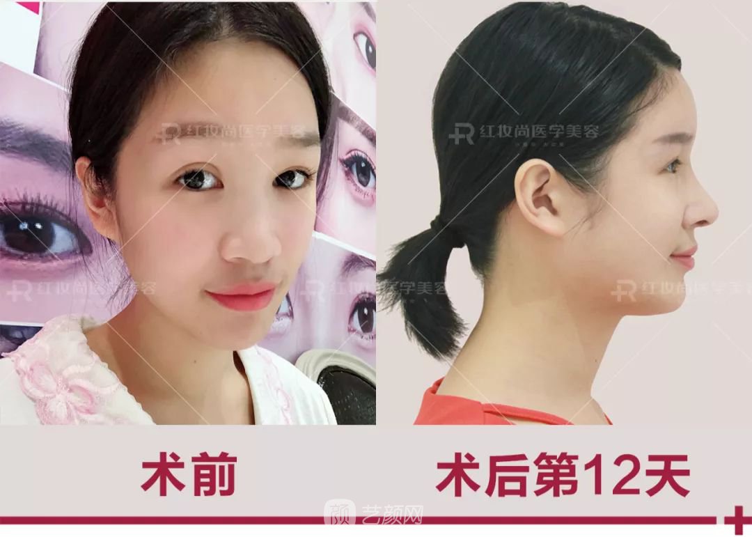 【蛻變?nèi)沼洝拷^美側(cè)顏的秘密——分享我的美鼻之旅~