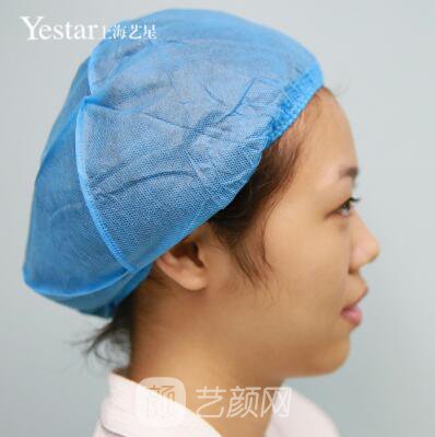 上海藝星切開雙眼皮案例，論雙眼皮的重要性