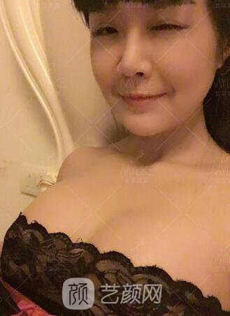 產后媽媽假體隆胸真實案例恢復過程