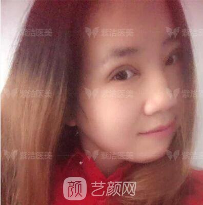 北京紫潔醫(yī)療美容全切雙眼皮案例過(guò)程恢復(fù)