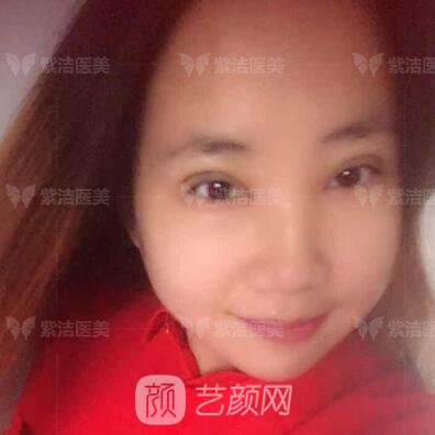 北京紫潔醫(yī)療美容全切雙眼皮案例過(guò)程恢復(fù)