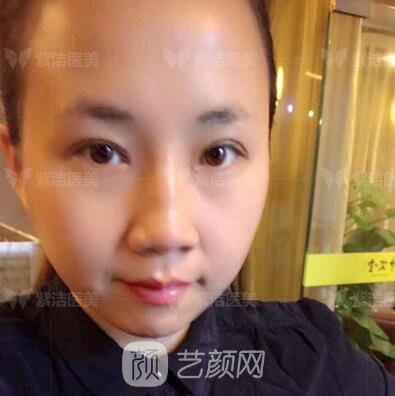 北京紫潔醫(yī)療美容全切雙眼皮案例過(guò)程恢復(fù)