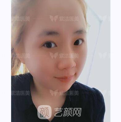 北京紫潔醫(yī)療美容全切雙眼皮案例過(guò)程恢復(fù)