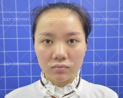 耳軟骨隆鼻術(shù)后一個(gè)月的果，真實(shí)日記一則給大家看看~