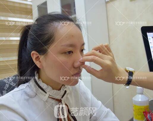 耳軟骨隆鼻術(shù)后一個(gè)月的果，真實(shí)日記一則給大家看看~