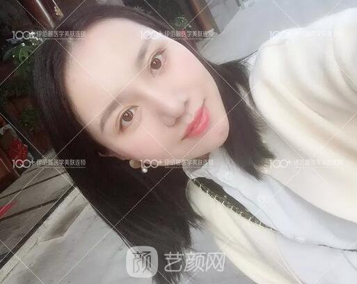 耳軟骨隆鼻術(shù)后一個(gè)月的果，真實(shí)日記一則給大家看看~