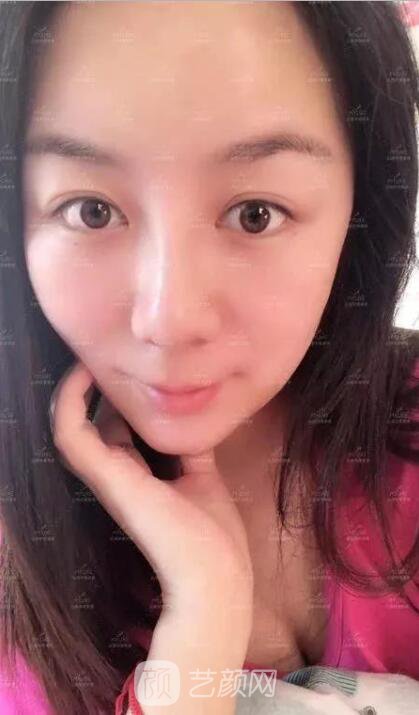 美萊假體隆鼻真實(shí)案例