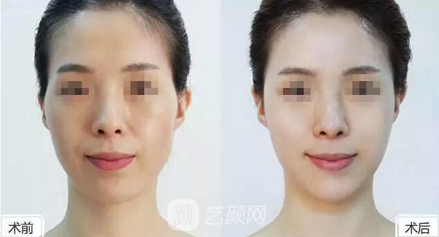 瀘州玻尿酸豐太陽穴需要多少錢?