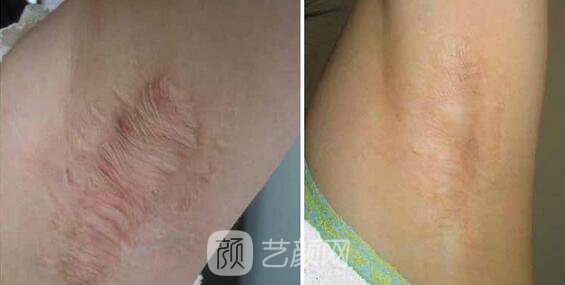 我去做了燒傷疤痕整形手術(shù)，現(xiàn)在已恢復(fù)如此了