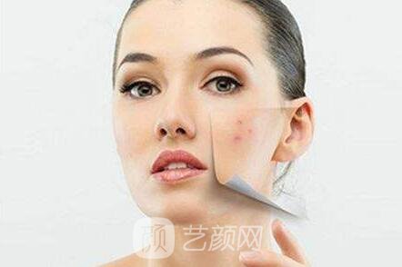 長沙雅美紅藍(lán)光祛痘果超棒