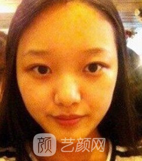 實拍隆鼻拆線后鼻子恢復果圖片