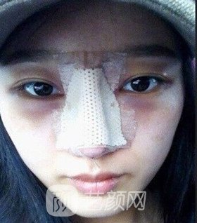 實拍隆鼻拆線后鼻子恢復果圖片