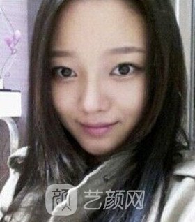 實拍隆鼻拆線后鼻子恢復果圖片