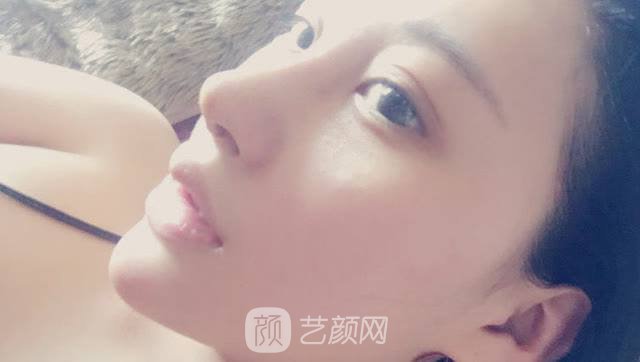 隆鼻+面部脂肪移植后變靚女告別單身