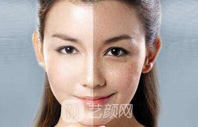 沒(méi)有斑 男票再也不會(huì)嫌棄我了