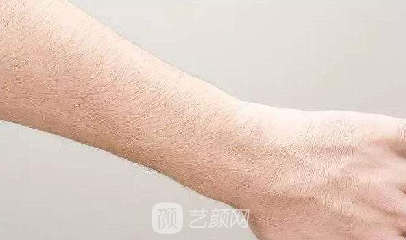 深圳翠綠寶石激光脫毛如何？我們一起來了解一下