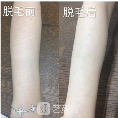 深圳翠綠寶石激光脫毛如何？我們一起來了解一下