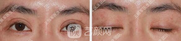 修復眼睛術前情況