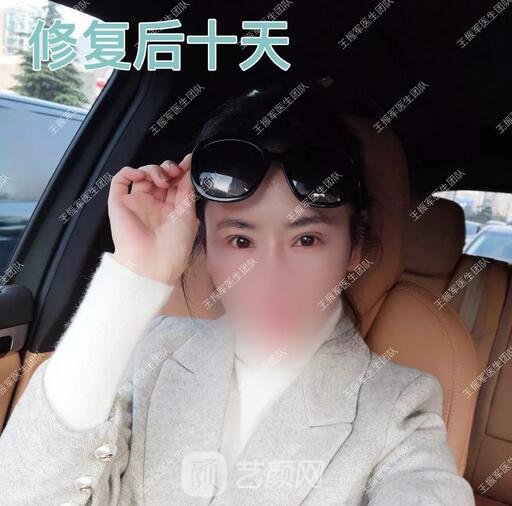 雙眼皮修復術后十天果圖