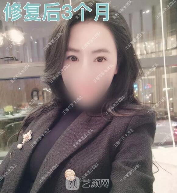 雙眼皮修復后3個月