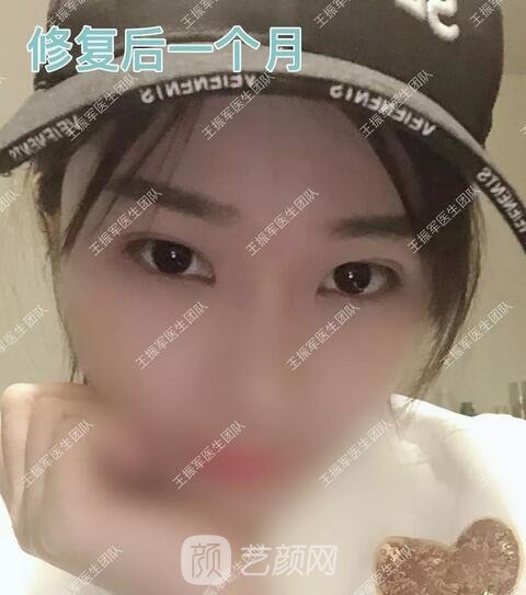 修復術后一個月果圖