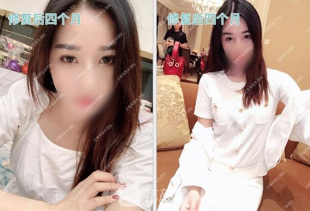 修復術后四個月果圖