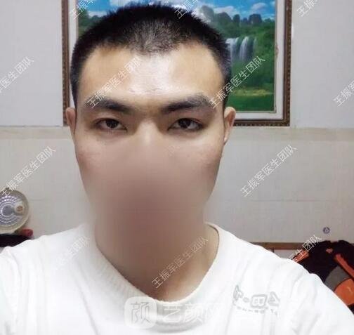 眼部整形手術(shù)