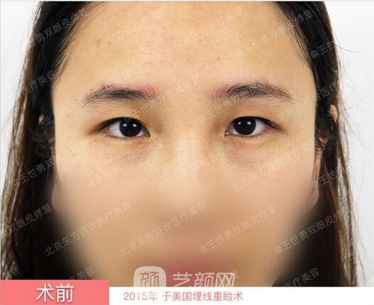 修復(fù)雙眼皮術(shù)前照