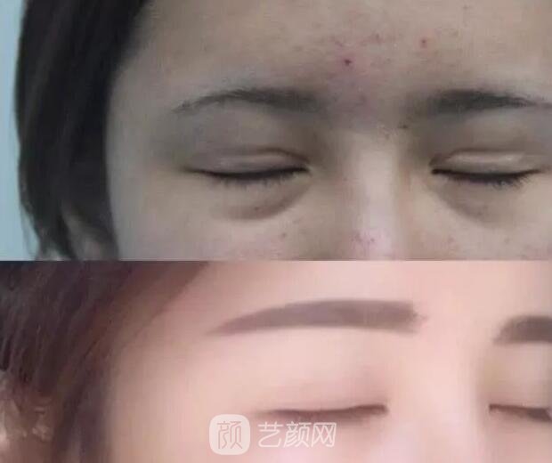 雙眼皮修復(fù)手術(shù)果圖