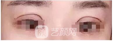 雙眼皮過寬