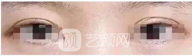 雙眼皮弧度不佳