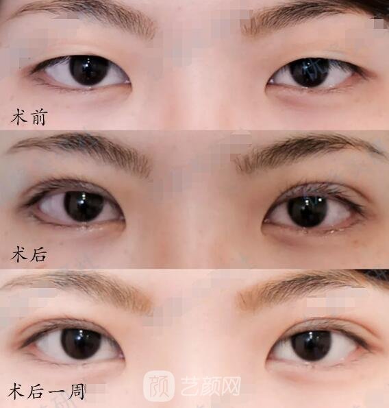 埋線雙眼皮案例圖