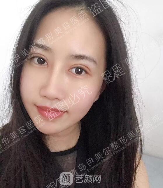 雙眼皮術(shù)后7天果圖