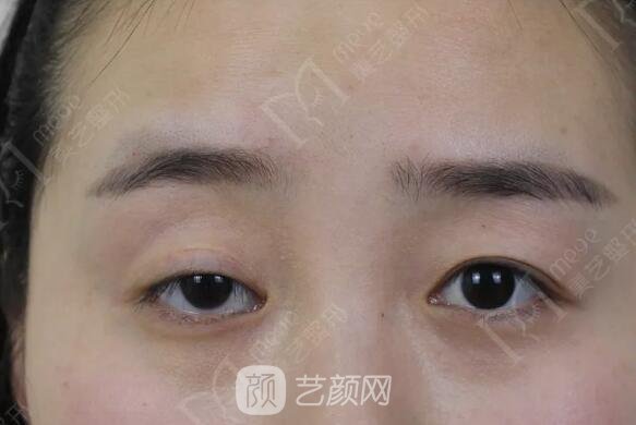 上瞼下垂如果不重視雙眼皮做了也白做！