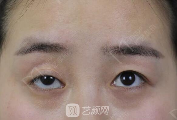 上瞼下垂如果不重視雙眼皮做了也白做！