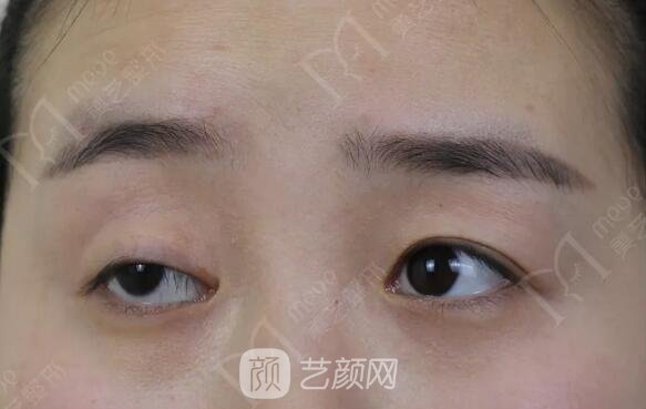 上瞼下垂如果不重視雙眼皮做了也白做！