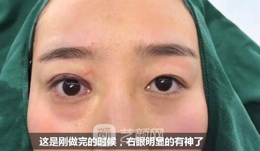 上瞼下垂如果不重視雙眼皮做了也白做！