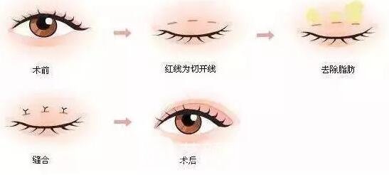 部分切開微創(chuàng)法雙眼皮