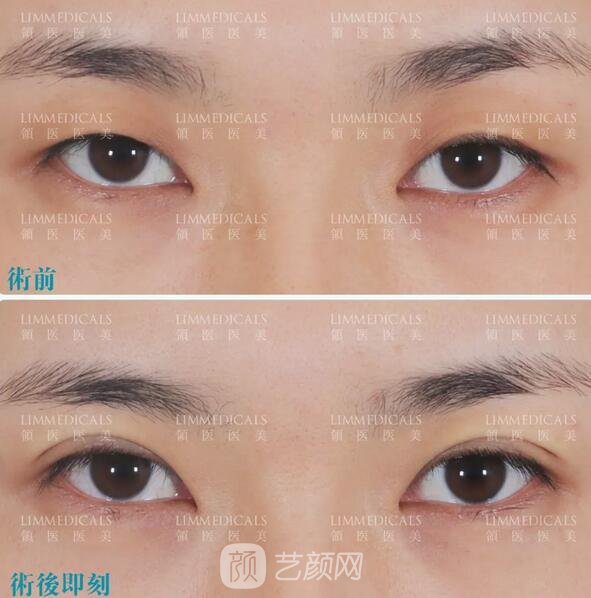 雙眼皮案例圖