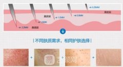 微針滾輪可以生發(fā)治禿頂嗎?有嗎?會(huì)傷害毛囊嗎?