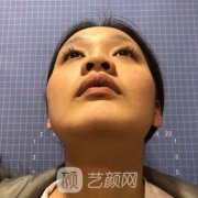 長(zhǎng)沙湘雅醫(yī)院隆鼻案例，