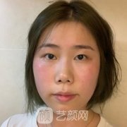 李慶春雙眼皮案例，眼部