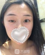 張樹功雙眼皮修復(fù)案例，