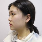 成都楊迪雙眼皮修復案例