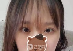 陳輝雙眼皮修復(fù)案例，修